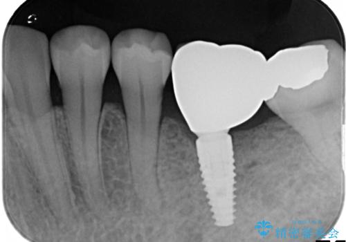 見えない歯周病 長期予後を見据えてインプラントにの治療後
