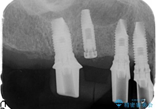 他院で中途半端に終わってしまったインプラント治療 の治療中