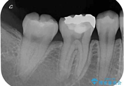 目立つ奥歯の銀歯をセラミックインレーにの治療前