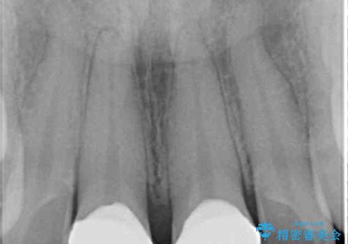 前歯の隙間をオールセラミックで閉じるの治療後