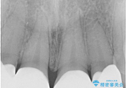 まだらな色の前歯をきれいにしたい セラミック治療による見た目の改善の治療後