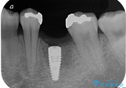 深い虫歯により抜歯となった奥歯　インプラント治療でかみ合わせを回復するの治療中