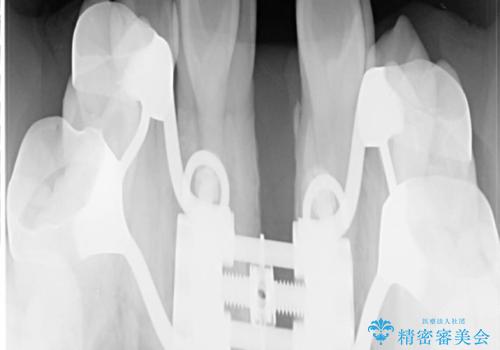 人生が変わる 困難を極める咬合状態に歯列矯正単独で挑戦するの治療中