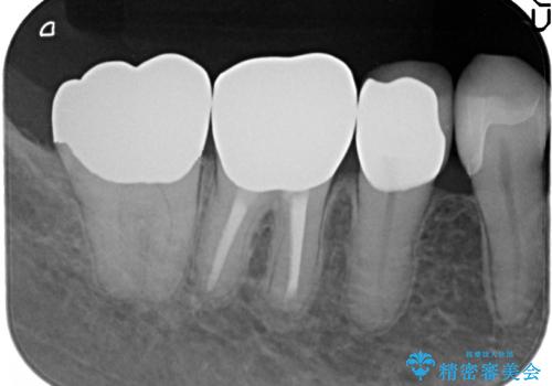 オールセラミッククラウン PGA(ゴールド)クラウン 古い銀歯の治療の治療後