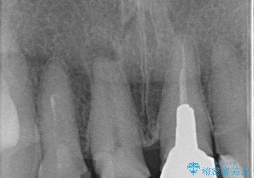前歯の審美改善の治療前