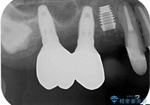 薄い骨にもインプラントを スプリットクレスト+ショートインプラントの応用の治療中