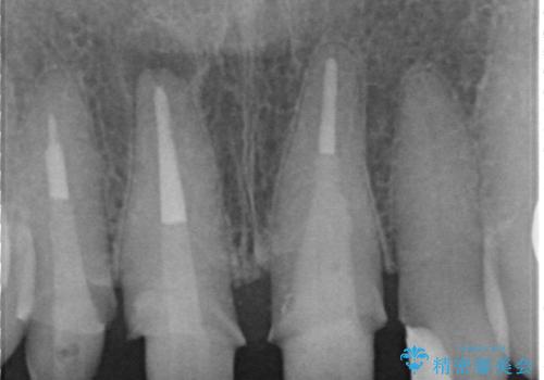 前歯の審美改善の治療中