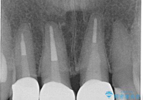 前歯の審美改善の治療後