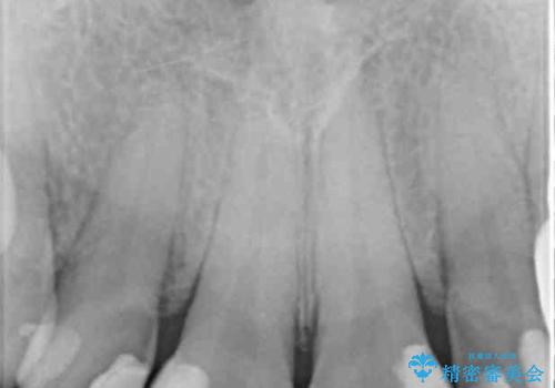 前歯の虫歯 つぎはぎの歯をセラミックにの治療前