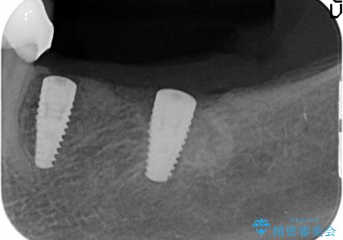 歯を失い噛めない、インプラントによる咬合機能回復の治療中