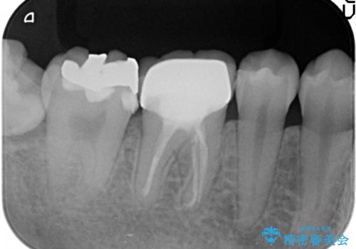 セラミックインレー　古い銀歯の治療の治療前