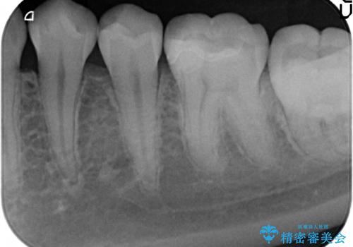 セラミックインレー　しみる歯の治療の治療後