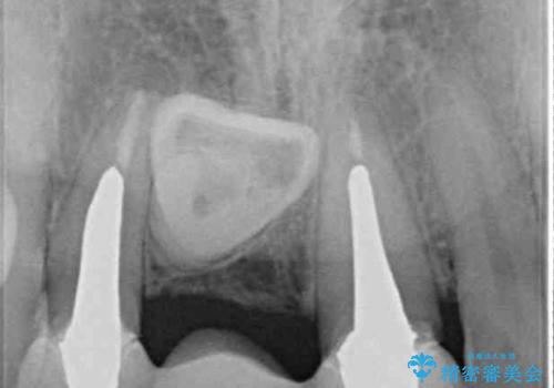 歯肉から血が 前歯のオールセラミックブリッジの再製作の治療前