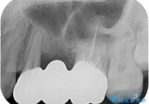 異臭のする歯を抜歯 奥歯のセラミックブリッジ治療の治療後