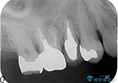 歯周外科・根管治療による長期予後を期待する奥歯の治療の治療前
