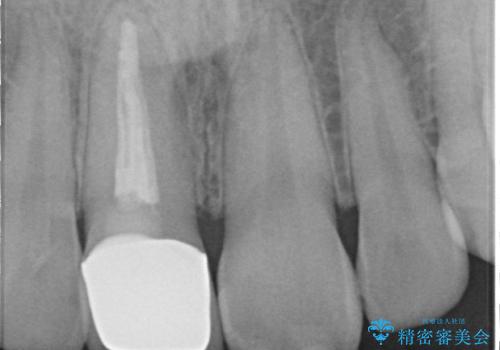 前歯をきれいにしたい ジルコニアクラウンによる審美治療の治療後