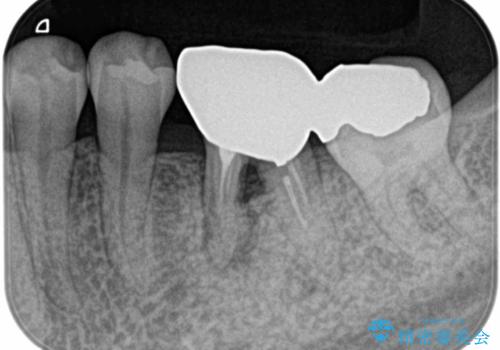 見えない歯周病　長期予後を見据えてインプラントにの治療前