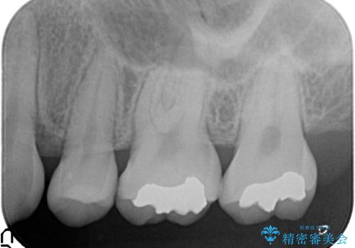 一度治療した歯が虫歯に　セラミックインレーで治療の治療前