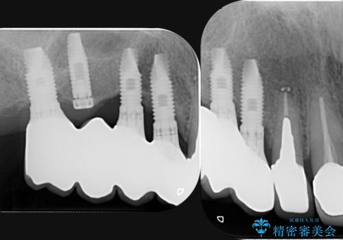 他院で中途半端に終わってしまったインプラント治療 の治療後