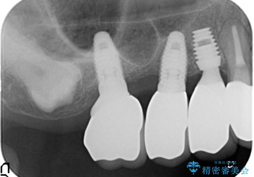 薄い骨にもインプラントを スプリットクレスト+ショートインプラントの応用の治療後