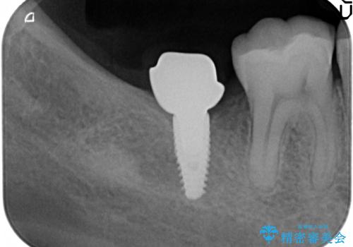 [20代男性] インプラント　失った歯の治療の治療中