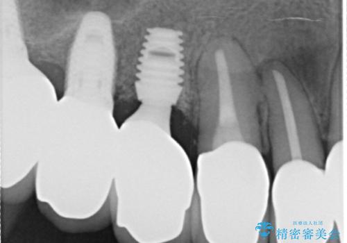 前歯の低クオリティな治療の実態 妥協無い治療で根本からやり治すの治療後