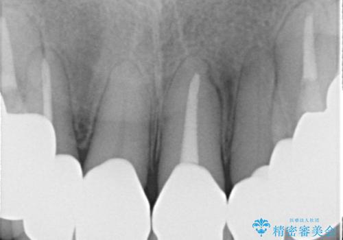 前歯の低クオリティな治療の実態 妥協無い治療で根本からやり治すの治療後