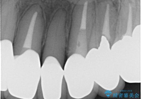 前歯の低クオリティな治療の実態 妥協無い治療で根本からやり治すの治療後