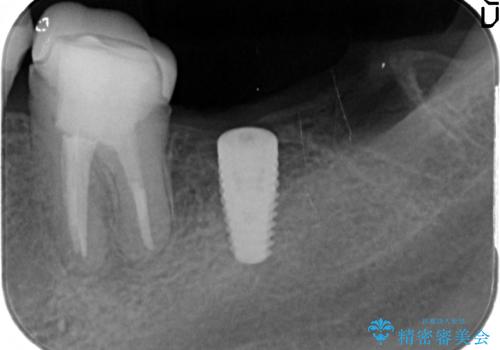 最後方臼歯のインプラント補綴
