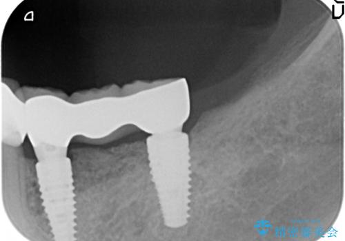歯を失い噛めない、インプラントによる咬合機能回復の治療後