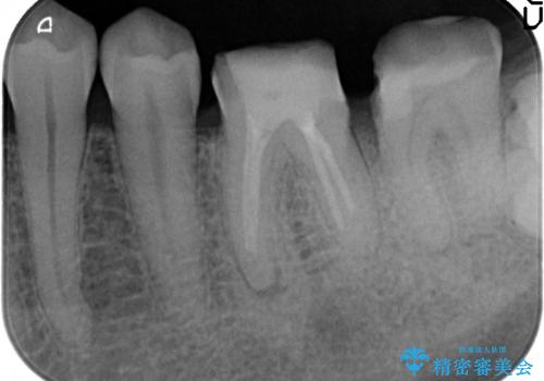 歯冠長延長術を併用した審美的歯科治療の治療後