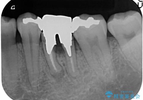 深い虫歯により抜歯となった奥歯　インプラント治療でかみ合わせを回復するの症例 治療前