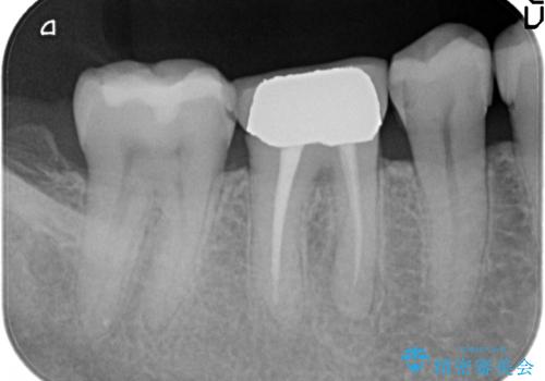 咬んだ時の違和感 顕微鏡で発見された歯の穴を処置し、かみ合わせを回復するの治療前