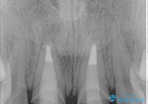 短期集中  前歯審美治療の治療中
