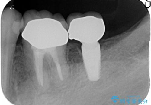 最後方臼歯のインプラント補綴の治療後