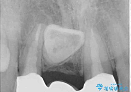 歯肉から血が 前歯のオールセラミックブリッジの再製作の治療後