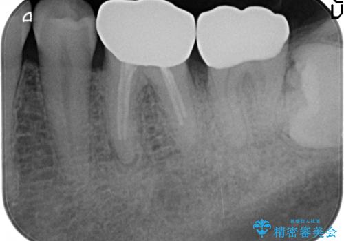 歯冠長延長術を併用した審美的歯科治療の治療後