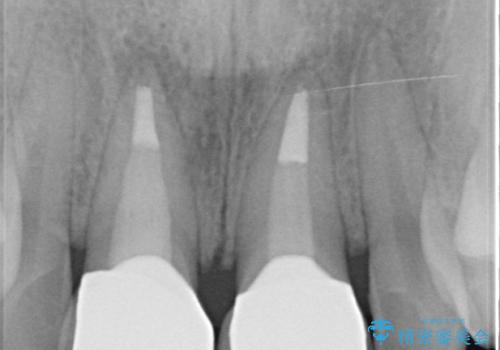 短期集中  前歯審美治療