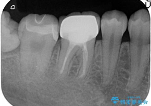 セラミックインレー　古い銀歯の治療の治療後