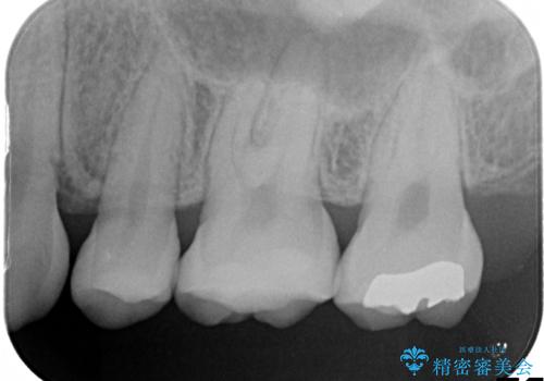 一度治療した歯が虫歯に　セラミックインレーで治療の治療後