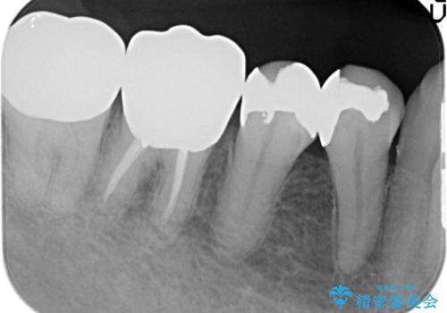 オールセラミッククラウン PGA(ゴールド)クラウン 古い銀歯の治療の治療前