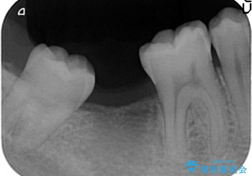 [20代男性] インプラント　失った歯の治療の治療前