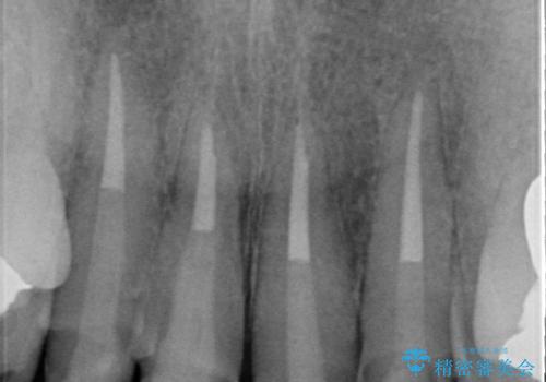 歯茎の黒ずみがきになる 前歯の見た目を改善したいの治療中