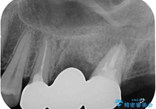 長い間虫歯を放置 奥歯のブリッジ治療の治療後