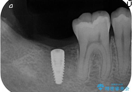 [20代男性] インプラント　失った歯の治療の治療前