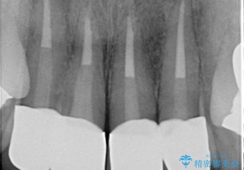 歯茎の黒ずみがきになる 前歯の見た目を改善したいの治療後