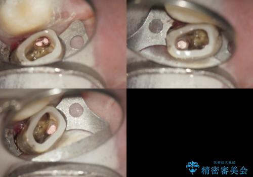 歯周外科・根管治療による長期予後を期待する奥歯の治療の治療中