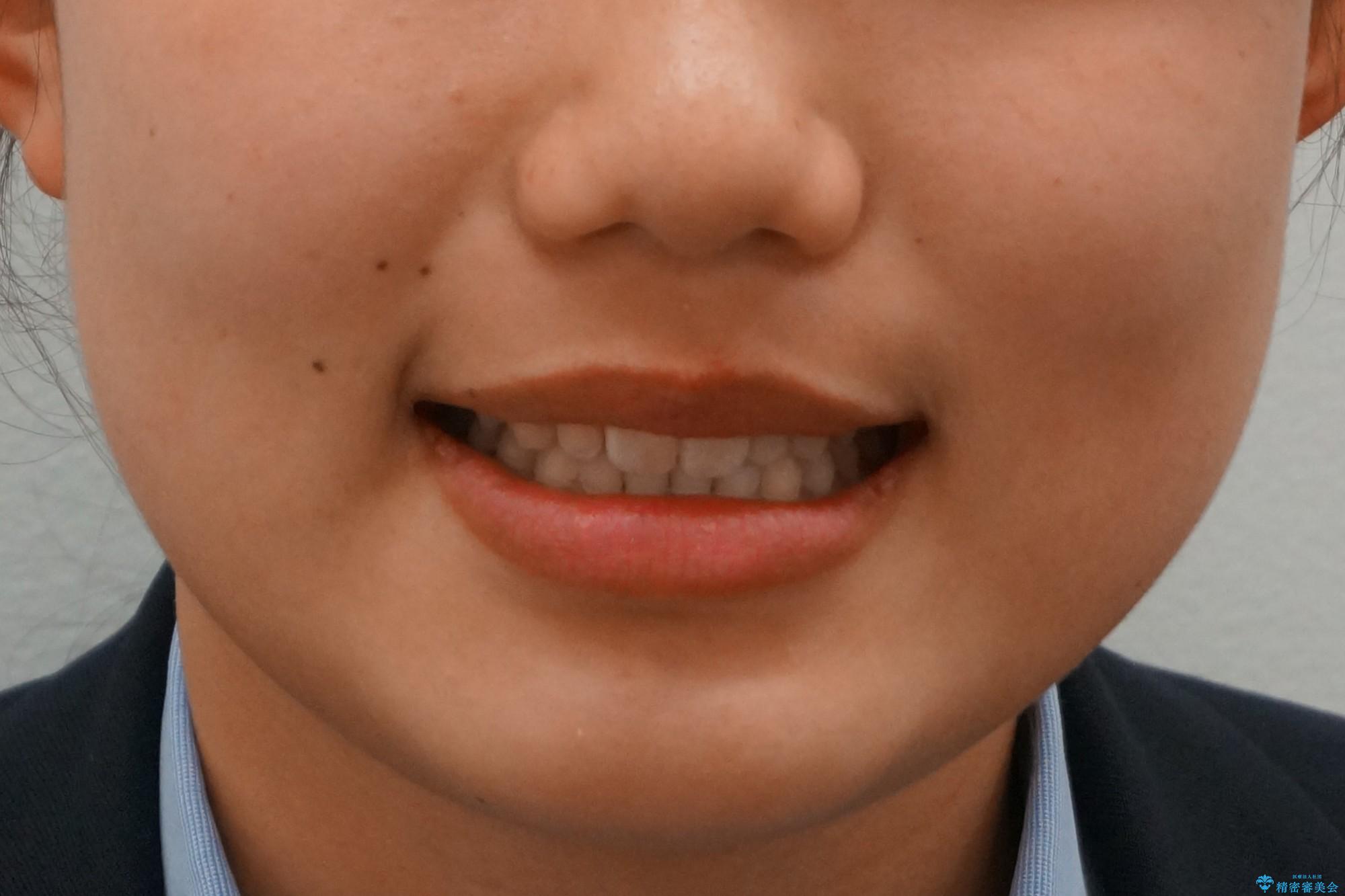 前歯のすきま 矯正治療とセラミックで小さな歯を形良くの治療後(顔貌)