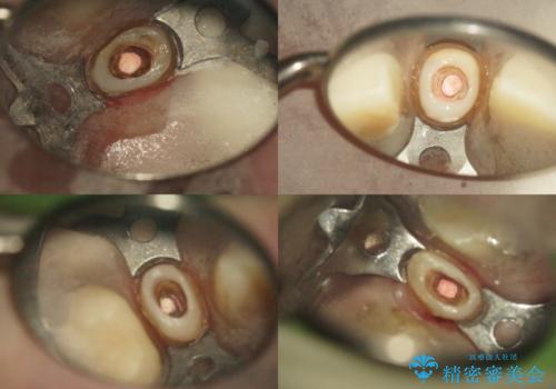 前歯の低クオリティな治療の実態 妥協無い治療で根本からやり治すの治療中