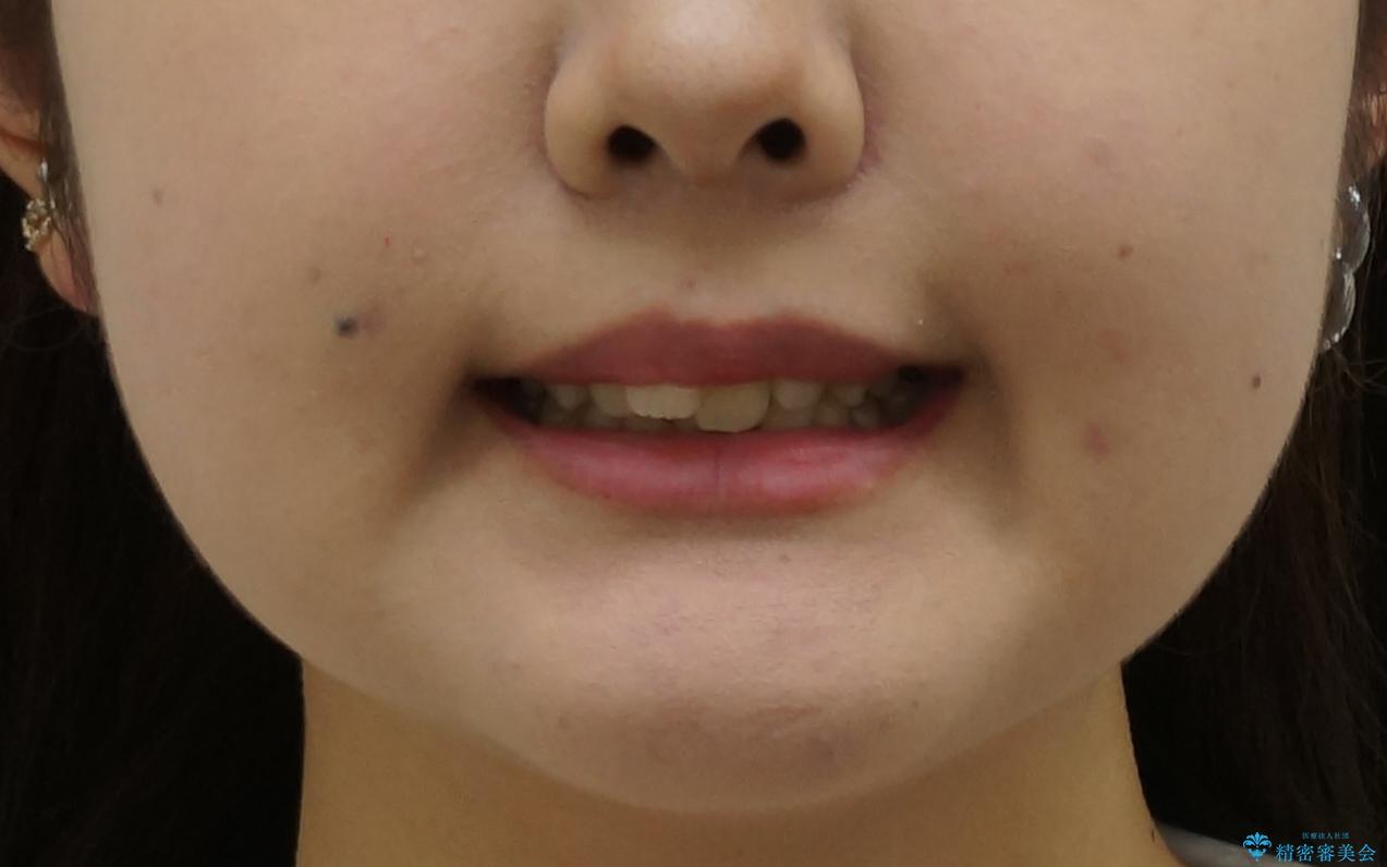 出っ歯をセラミックで治したい の治療前(顔貌)